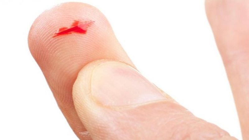mo thay ngon tay 3 Mơ bị chặt ngón tay là điềm báo xấu