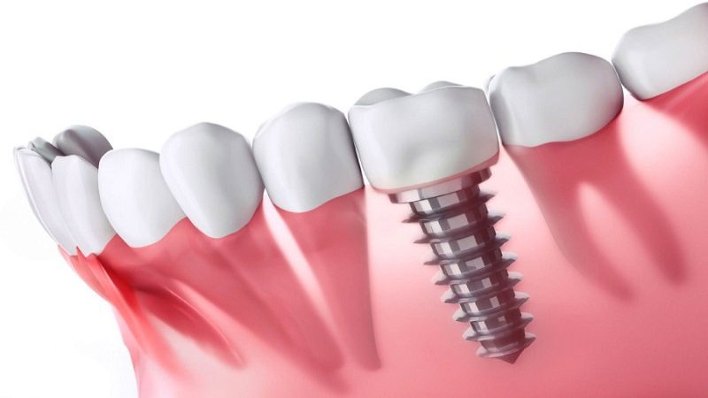 mo thay rung rang 2 Mơ thấy rụng răng rồi trồng răng giả
